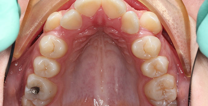 Female upper teeth before treatment for severe dental crowding and misalignment braces required